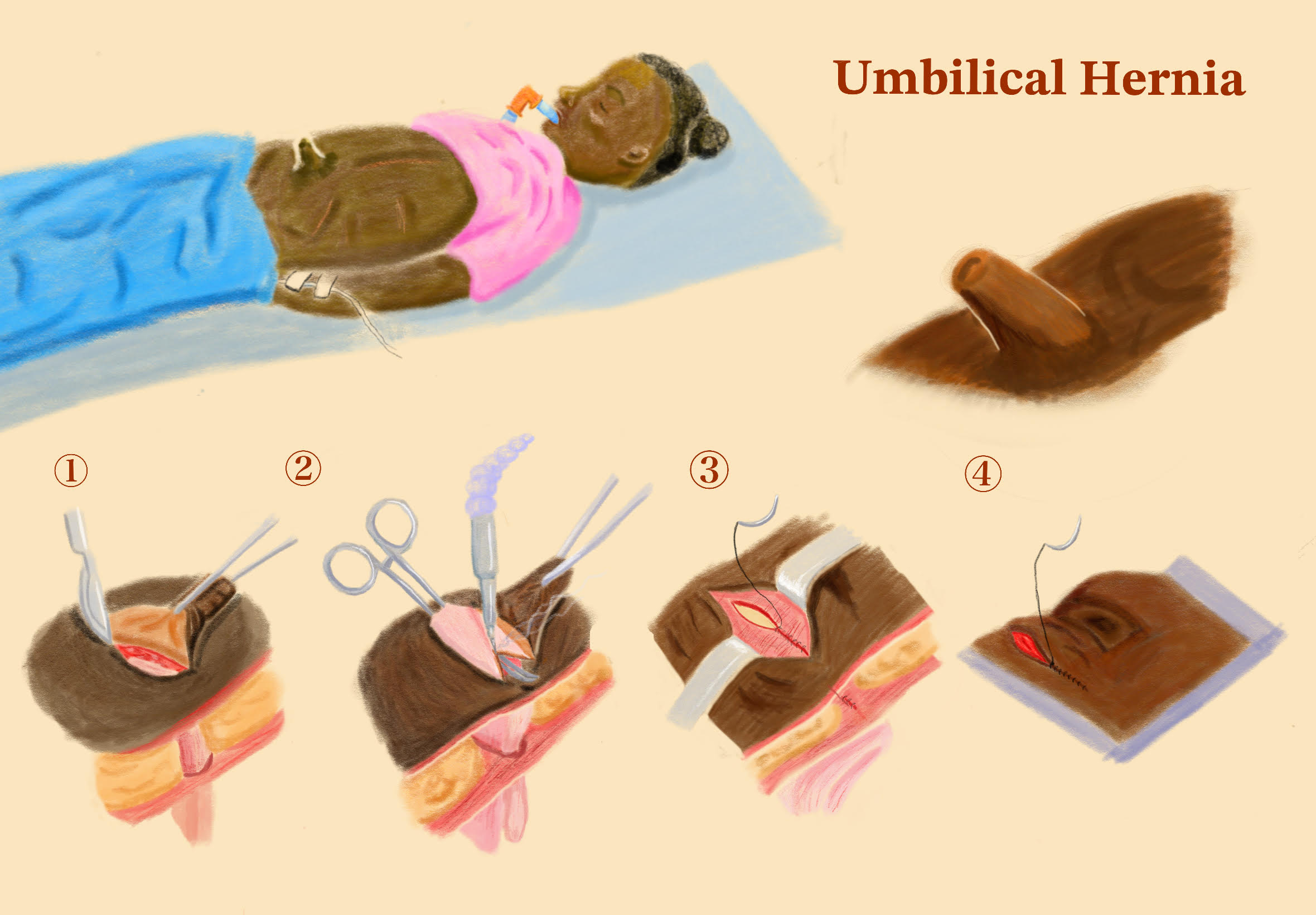 メディカルイラストレーションで提示された臍ヘルニアの手術方法をわかりやすく伝えるスケッチ